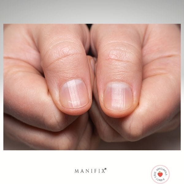 Längsrillen Fingernägel